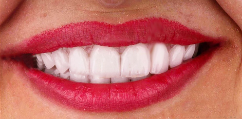 veneers on gapped teeth veneers on gapped teeth