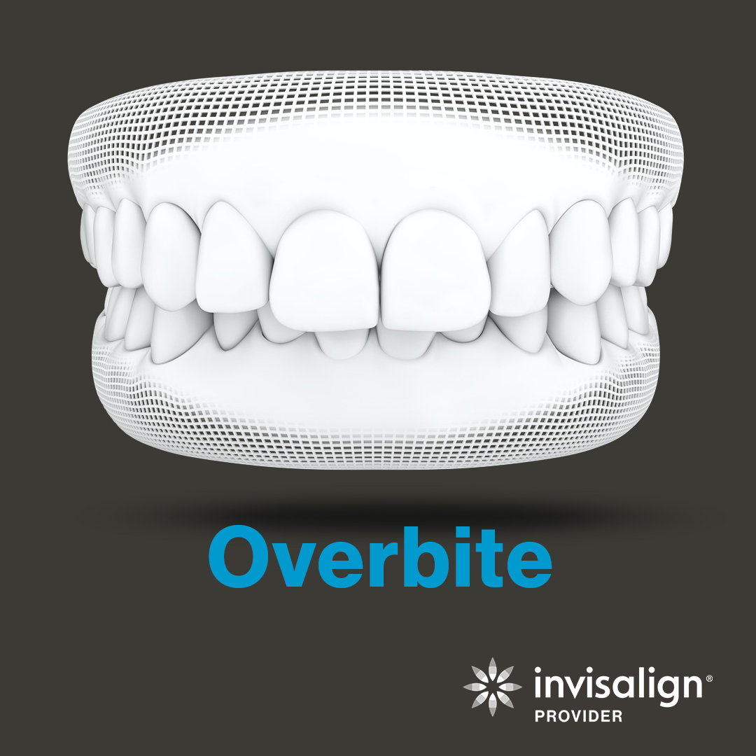 OverBite